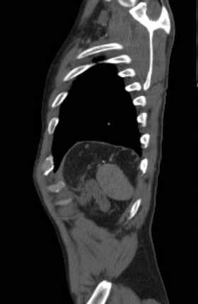 File:Aortic dissection - Stanford type B (Radiopaedia 73648-84437 C 14).jpg