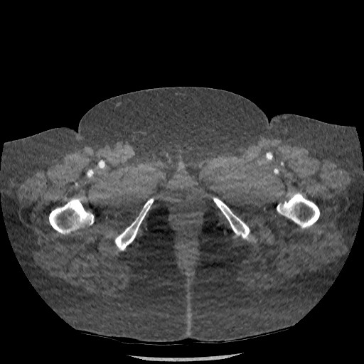 File:Aortic dissection - Stanford type B (Radiopaedia 88281-104910 A 169).jpg