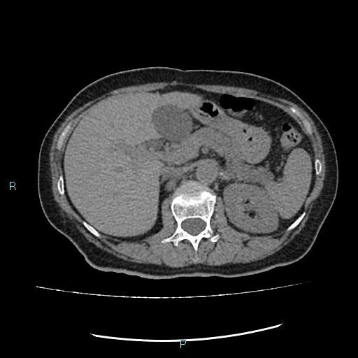 File:Aortic dissection extended to lusory artery (Radiopaedia 43686-47136 Axial non-contrast 31).jpg