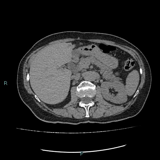 File:Aortic dissection extended to lusory artery (Radiopaedia 43686-47136 Axial non-contrast 32).jpg