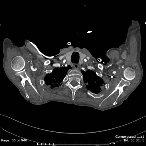 File:Aortic dissection with extension into aortic arch branches (Radiopaedia 64402-73204 B 56).jpg