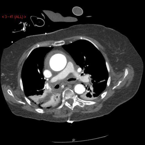 Aortic intramural hematoma (Radiopaedia 27746-28001 A 41).jpg