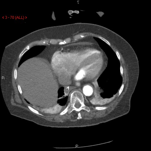 Aortic intramural hematoma (Radiopaedia 27746-28001 A 70).jpg