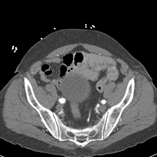 Aortic intramural hematoma (Radiopaedia 31139-31838 B 144).jpg