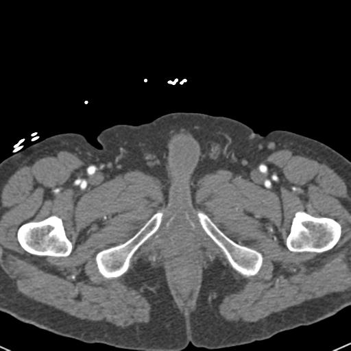Aortic intramural hematoma (Radiopaedia 31139-31838 B 180).jpg