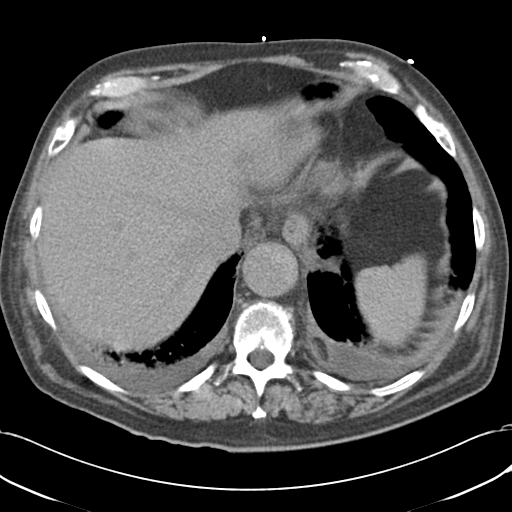 Aortic intramural hematoma (Radiopaedia 34260-35540 Axial non-contrast 52).png