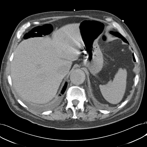 Aortic intramural hematoma (Radiopaedia 34260-35540 Axial non-contrast 55).png