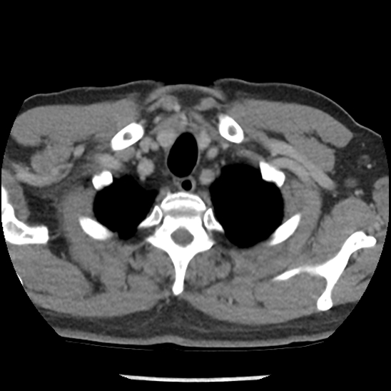 File:Aortic intramural hematoma (type B) (Radiopaedia 79323-92387 Axial C+ delayed 2).jpg