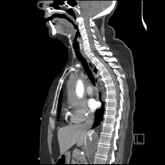Aortic intramural hematoma with dissection and intramural blood pool (Radiopaedia 77373-89491 D 41).jpg