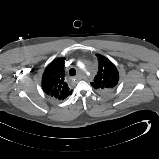 Aortic transection, diaphragmatic rupture and hemoperitoneum in a complex multitrauma patient (Radiopaedia 31701-32622 A 24).jpg
