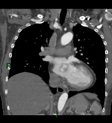 File:Aortic valve endocarditis (Radiopaedia 87209-103485 D 36).jpg