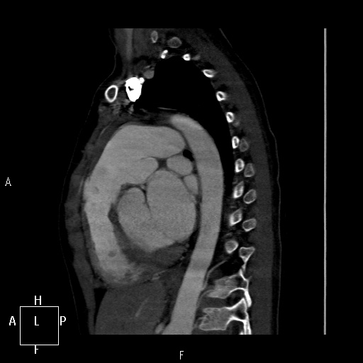 File:Aortopulmonary septal defect (Radiopaedia 41990-45013 Sagittal C+ CTPA 20).jpg