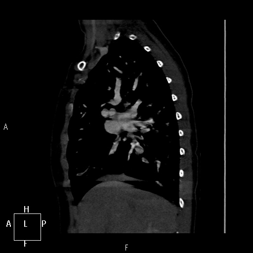 File:Aortopulmonary septal defect (Radiopaedia 41990-45013 Sagittal C+ CTPA 44).jpg