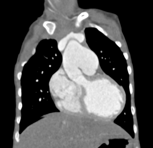 File:Aortopulmonary window, interrupted aortic arch and large PDA giving the descending aorta (Radiopaedia 35573-37074 D 20).jpg