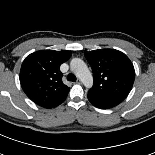 Apical lung mass mimic - neurogenic tumor (Radiopaedia 59918-67521 A 26).jpg