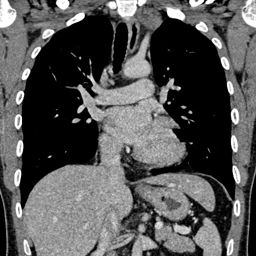 Apical lung mass mimic - neurogenic tumor (Radiopaedia 59918-67521 B 62).jpg