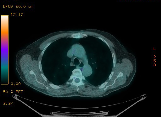 Appendiceal adenocarcinoma complicated by retroperitoneal abscess (Radiopaedia 58007-65041 Axial PET-CT 55).jpg