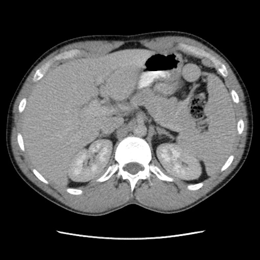 Appendicitis complicated by post-operative collection (Radiopaedia 35595-37113 A 17).jpg