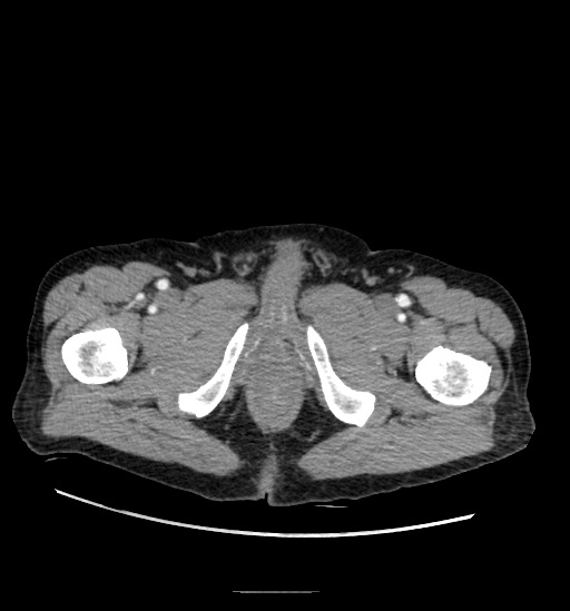 File:Appendicitis with localized perforation and abscess formation (Radiopaedia 49035-54130 A 92).jpg