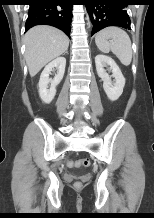 Appendicitis with thickening of the terminal ileum (Radiopaedia 42432-45550 B 41).png