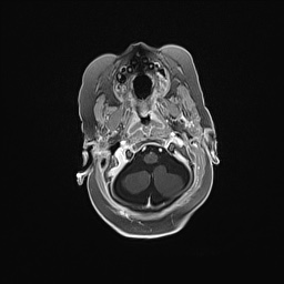 Aqueductal stenosis (Radiopaedia 73974-84802 Axial T1 C+ 40).jpg