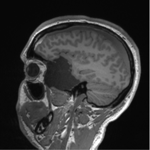 Arachnoid cyst with subdural hematoma (Radiopaedia 85892-101743 Sagittal T1 30).png