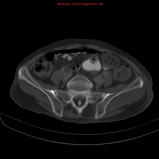 File:Arachnoiditis ossificans (Radiopaedia 51394-57136 Axial bone window 31).jpg