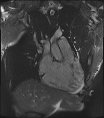 Arrhythmogenic right ventricular cardiomyopathy (Radiopaedia 57972-64966 CINE R2 SSFP 31).jpg