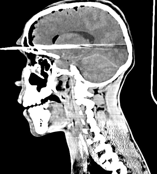 Arrow injury to the brain (Radiopaedia 72101-82607 H 39).jpg