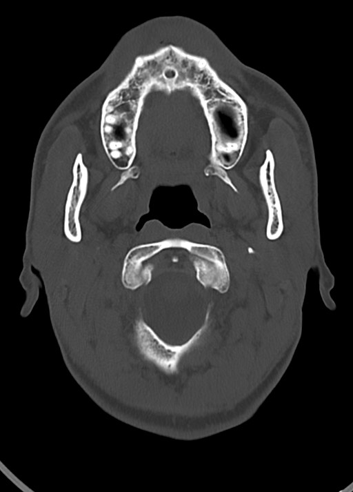 Arrow injury to the head (Radiopaedia 75266-86388 Axial bone window 39).jpg
