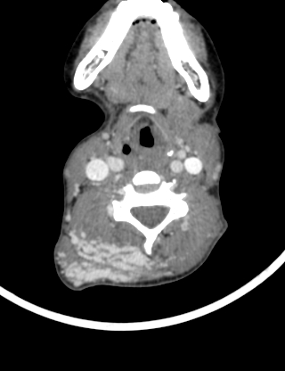File:Arteriovenous malformation of the neck (Radiopaedia 53935-60062 B 25).jpg