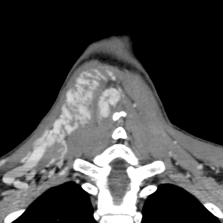 Arteriovenous malformation of the neck (Radiopaedia 53935-60062 D 43).jpg
