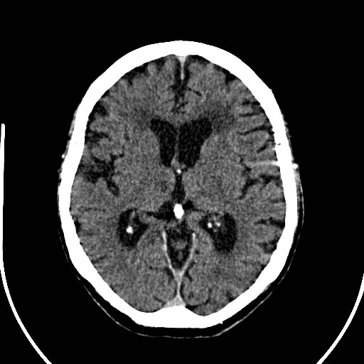 File:Artery of Percheron infarction (Radiopaedia 26307-26438 Axial non-contrast 19).jpg
