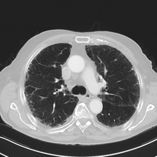 File:Asbestosis (Radiopaedia 56192-62864 Axial lung window 26).png
