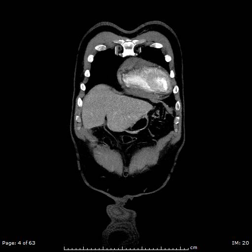 Ascending aortic aneurysm (Radiopaedia 50086-55404 B 4).jpg