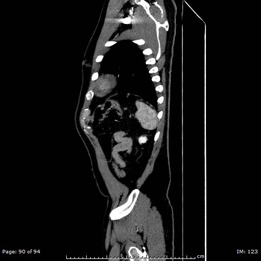 Ascending aortic aneurysm (Radiopaedia 50086-55404 C 64).jpg