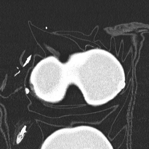 File:Aspergilloma (Radiopaedia 26223-26347 Coronal lung window 1).jpg
