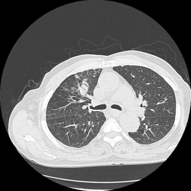 Aspergilloma (Radiopaedia 44592-48327 Axial lung window 32).jpg