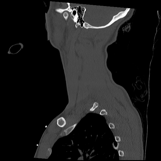 File:Atlanto-occipital dissociation (Traynelis type 1), C2 teardrop fracture, C6-7 facet joint dislocation (Radiopaedia 87655-104061 Sagittal bone window 58).jpg