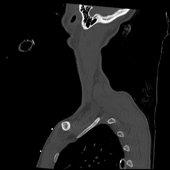 Atlanto-occipital dissociation (Traynelis type 1), C2 teardrop fracture, C6-7 facet joint dislocation (Radiopaedia 87655-104061 Sagittal bone window 65).jpg