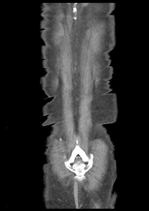 Atraumatic splenic rupture (Radiopaedia 42931-46160 B 55).png