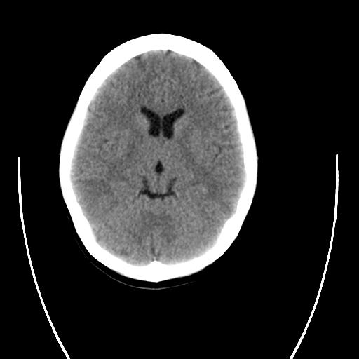 File:Atretic encephalocoele with inferior vermis hypoplasia (Radiopaedia 30443-31107 C 1).jpg