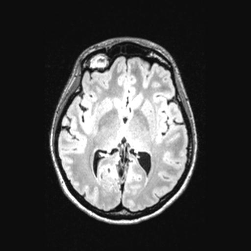 Atretic encephalocoele with inferior vermis hypoplasia (Radiopaedia 30443-31108 Axial 81).jpg