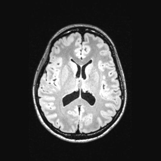 Atretic encephalocoele with inferior vermis hypoplasia (Radiopaedia 30443-31108 Axial 91).jpg