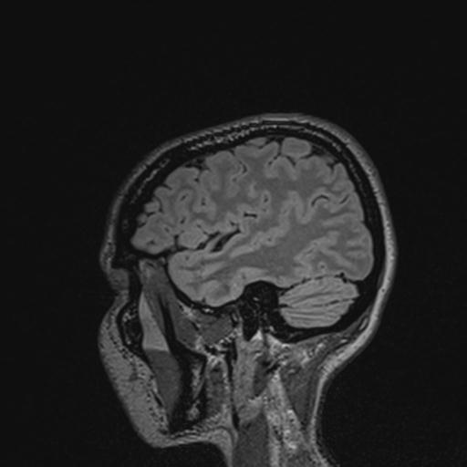 Atretic encephalocoele with inferior vermis hypoplasia (Radiopaedia 30443-31108 Sagittal FLAIR 123).jpg