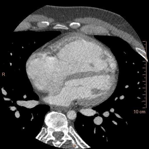 Atrial septal defect (upper sinus venosus type) with partial anomalous pulmonary venous return into superior vena cava (Radiopaedia 73228-83961 A 154).jpg