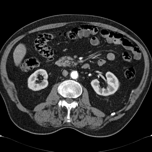 Atypical hepatocellular carcinoma (Radiopaedia 41744-44698 A 51).jpg