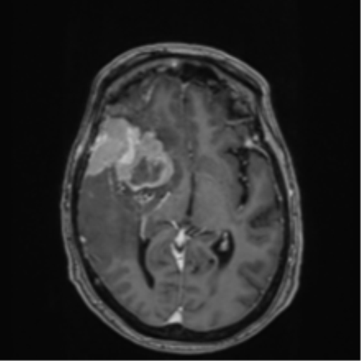 Atypical meningioma (WHO Grade II) (Radiopaedia 54742-60979 Axial T1 C+ 30).png