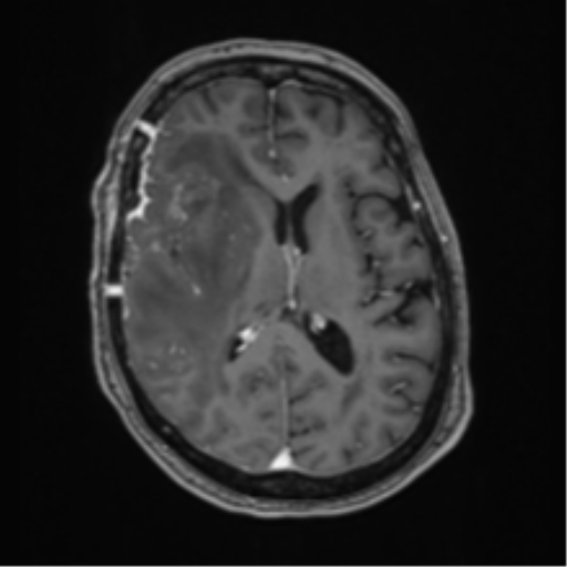 Atypical meningioma (WHO Grade II) (Radiopaedia 54742-60981 Axial T1 C+ 39).png