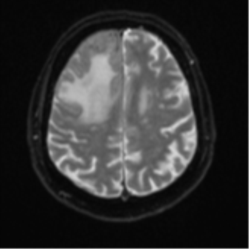 File:Atypical meningioma (WHO grade II) with brain invasion (Radiopaedia 57767-64729 Axial DWI 22).png